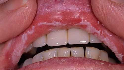 Острый псевдомембрано зный кандидоз представляет собой поражение губ, внутренней поверхности щек, языка инеба