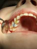 Болит зуб под пломбой